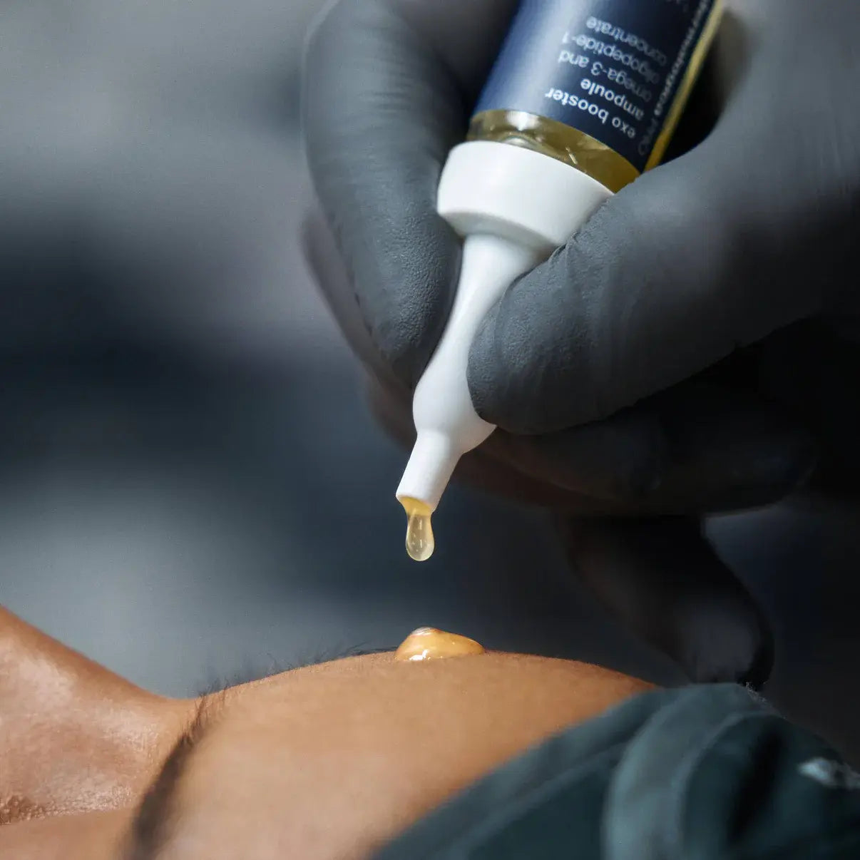 Microneedling treatment