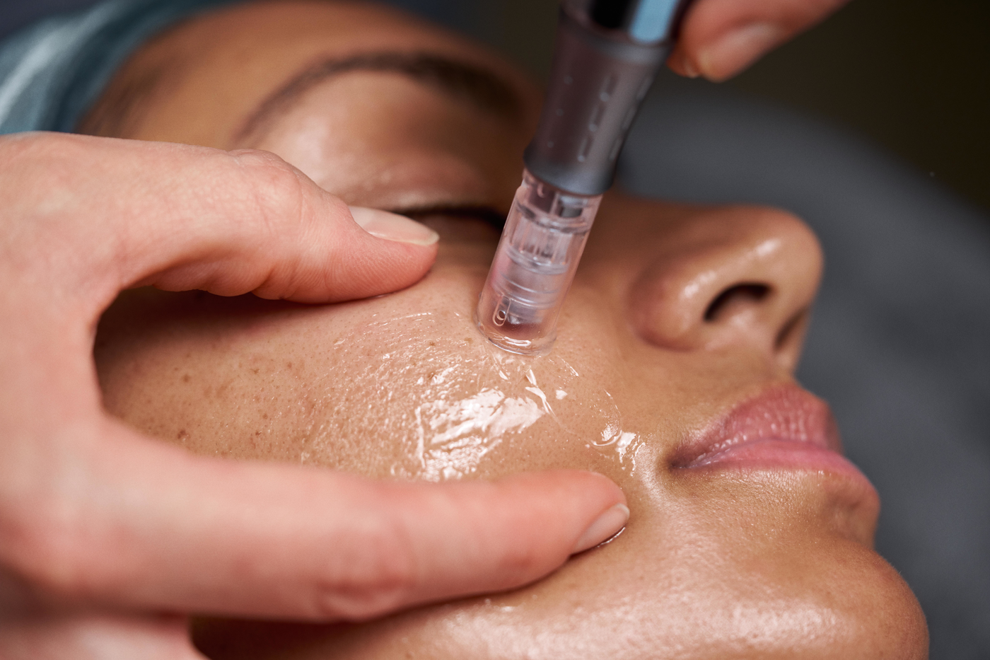 Microneedling treatment