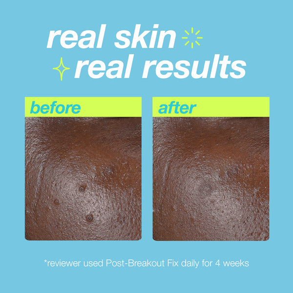 Close-up comparison of skin before and after using Dermalogica post-breakout fix. The before image shows blemishes and hyperpigmentation; the after image reveals smoother, clearer skin. Text reads, real skin, real results.