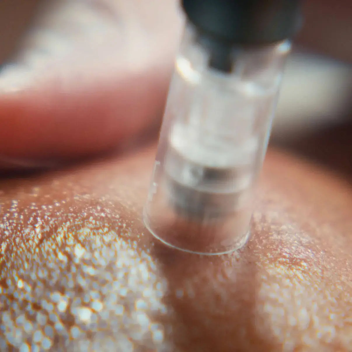 Microneedling treatment
