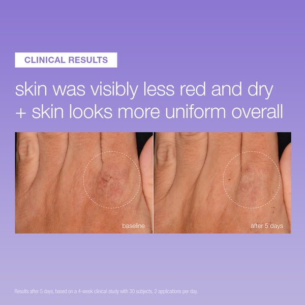Two close-up images of the back of a hand show reduced redness and dryness after 5 days of using Dermalogica South Africa’s stabilizing repair face + body serum; accompanying text highlights improved skin uniformity, a strengthened moisture barrier, and visible clinical results.