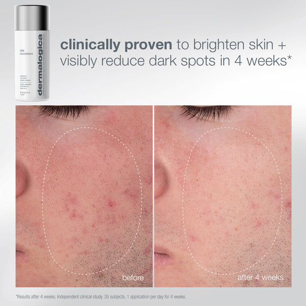 A bottle of pro ritual: exfoliate + glow set next to before and after close-up photos of a cheek, showing a reduction in skin redness and dark spots after four weeks for glowing skin.