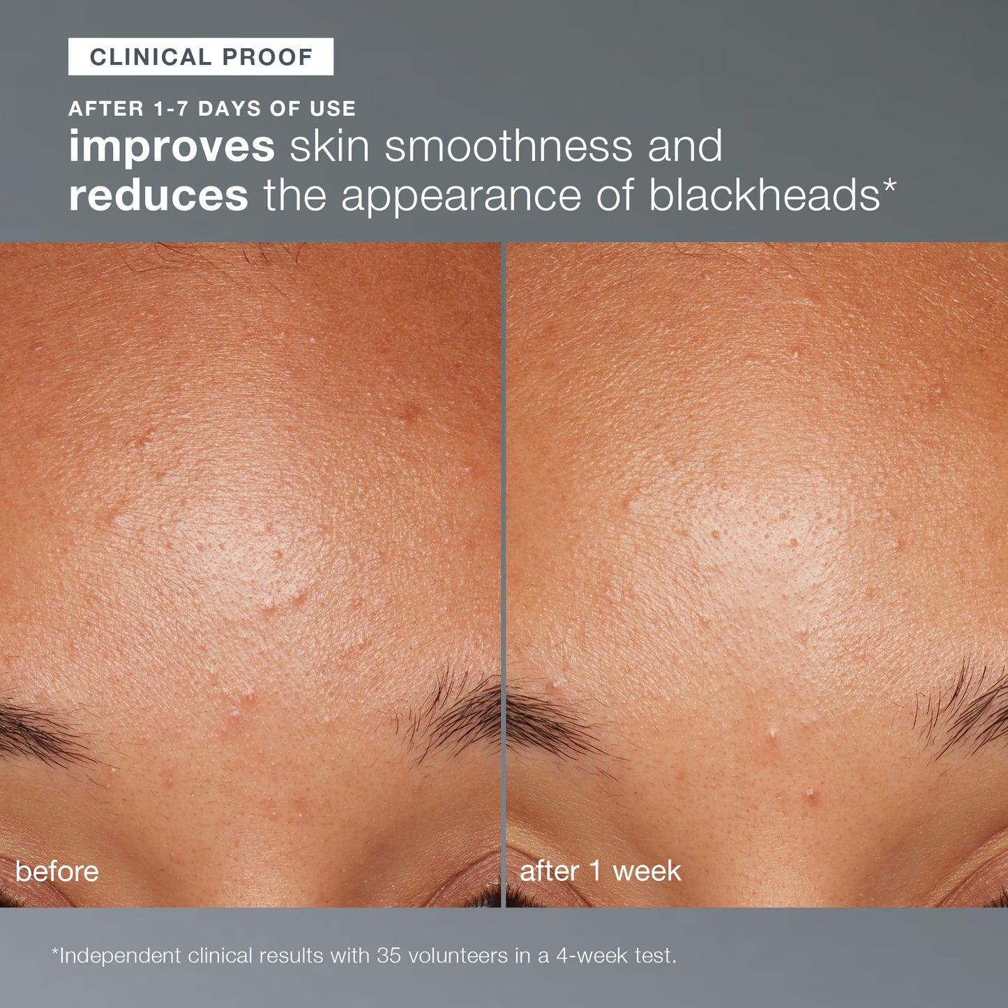 Side-by-side close-ups of a forehead show skin before and after 1 week using Dermalogica daily microfoliant, revealing smoother texture and fewer blackheads. Text highlights clinically proven, visible results.