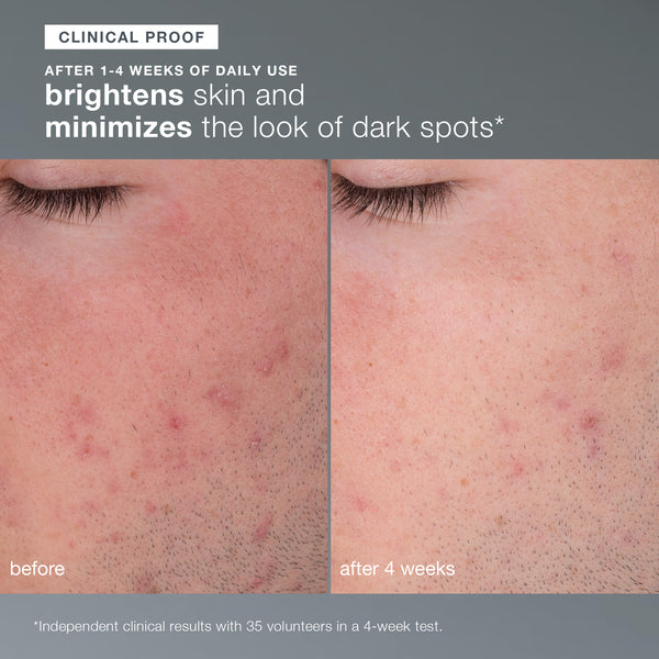 Side-by-side close-ups of a cheek and closed eye reveal fewer dark spots and brighter skin after 4 weeks of daily use of Dermalogica daily microfoliant. Text highlights clinical proof of minimized dark spots for noticeable skin brightening.