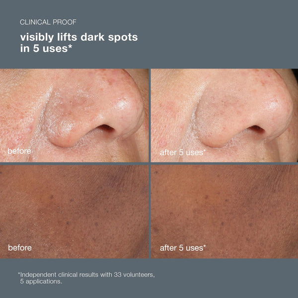 Close-up before and after images show reduced dark spots and hyperpigmentation on nose and cheeks after 5 uses of Dermalogica South Africa’s powerbright dark spot peel 50ml, with clinical proof of visibly lighter, more even-toned skin.