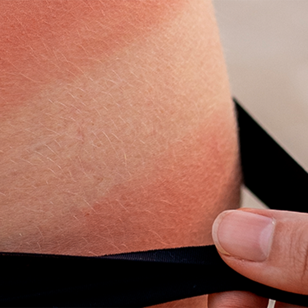 what is a sunburn?
