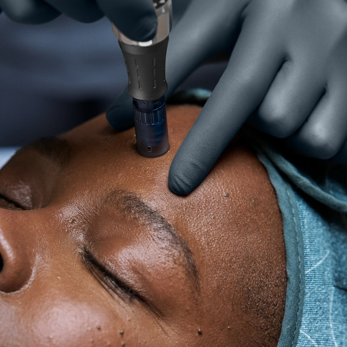 A skin therapist performs a microneedling treatment on a client's forehead.